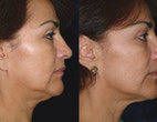 Lower face & neck treatment